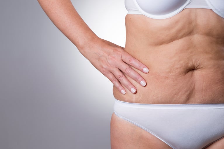 How to Minimize Loose Skin After Weight Loss Surgery